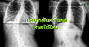 กระดูกสันหลังคด หายได้ไหม - เมดิก้า คลินิกเพิ่มความสูง